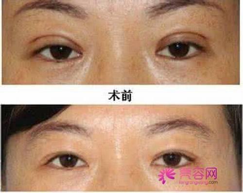 有一个话题不得不说:关于双眼皮修复,小编有话说!