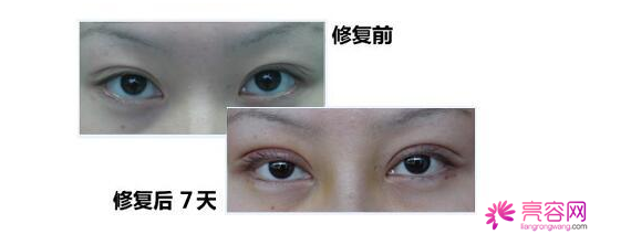 有一个话题不得不说:关于双眼皮修复,小编有话说!
