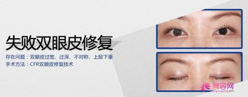有一个话题不得不说:关于双眼皮修复,小编有话说!