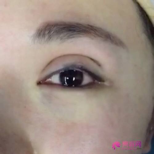 有一个话题不得不说:关于双眼皮修复,小编有话说!
