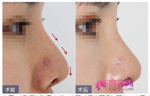 今天我们来说说什么叫隆鼻失败?