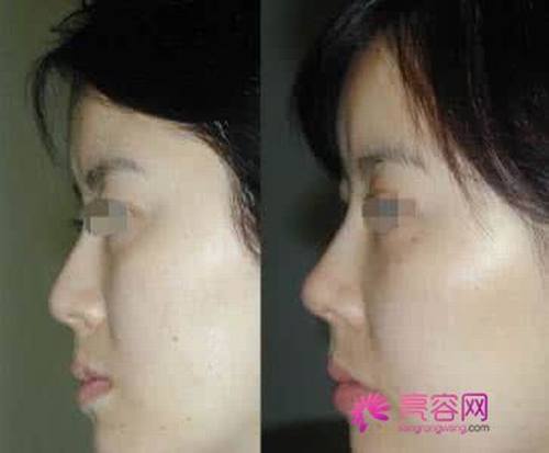今天我们来说说什么叫隆鼻失败?