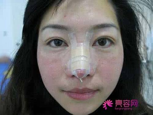 今天我们来说说什么叫隆鼻失败?