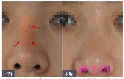 今天我们来说说什么叫隆鼻失败?