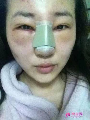 今天我们来说说什么叫隆鼻失败?