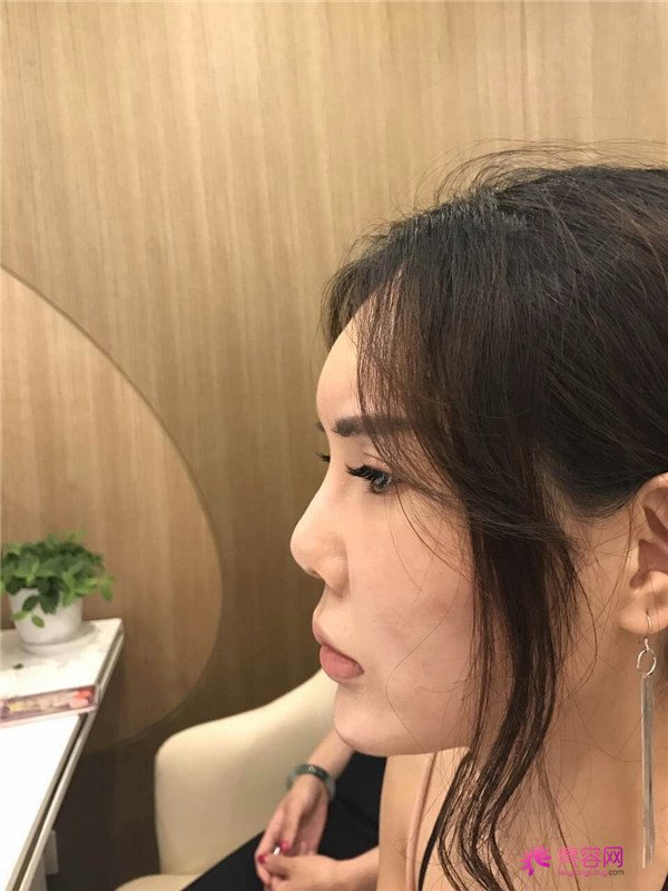 【鼻部手术】小仙女们,做完手术第一天就迫不及待想把自己这次的经历分享给大家了~~~