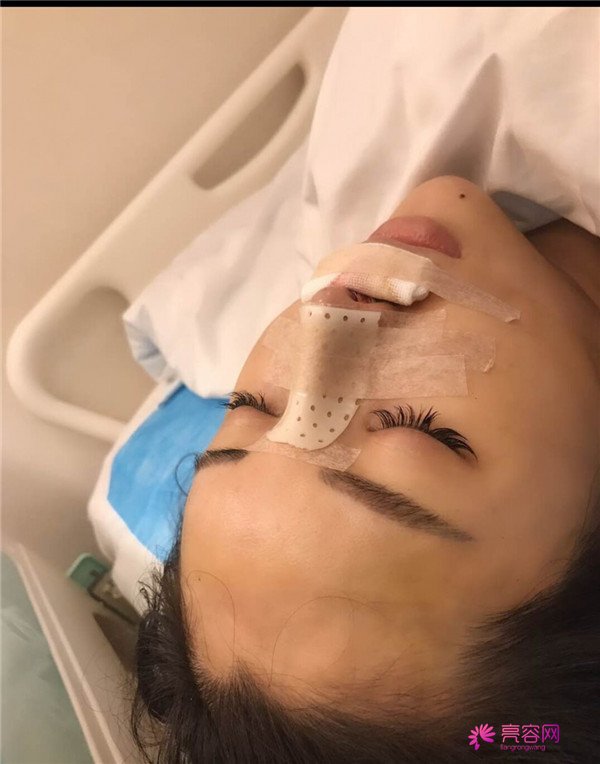【鼻部手术】小仙女们,做完手术第一天就迫不及待想把自己这次的经历分享给大家了~~~