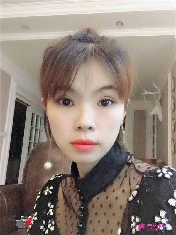 重庆双眼皮案例分享,能有这样的果也是很好看了,安排!!!!