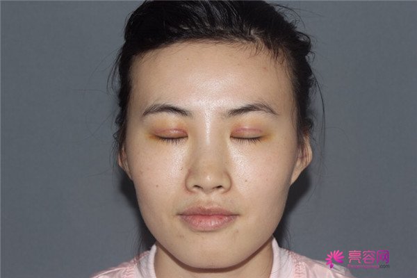 好羡慕那种不是太大宽眼皮的,小扇形的刘亦菲那种双眼皮,不过我现在也有啦~~哈哈