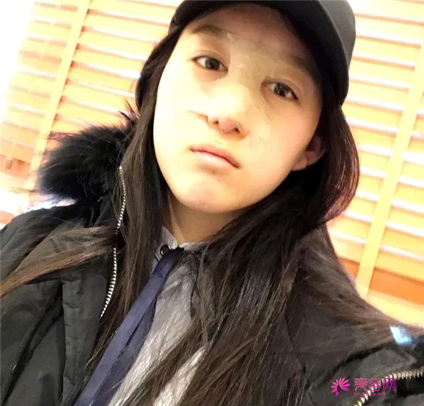 小仙女儿的鼻部手术案例分享连载(一)