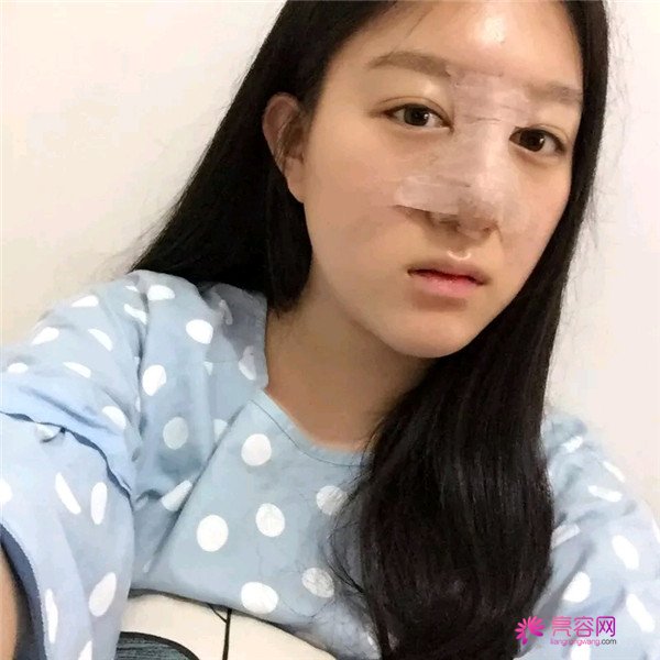 小仙女儿的鼻部手术案例分享连载(一)