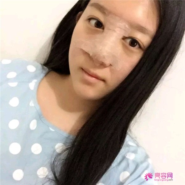 小仙女儿的鼻部手术案例分享连载(一)