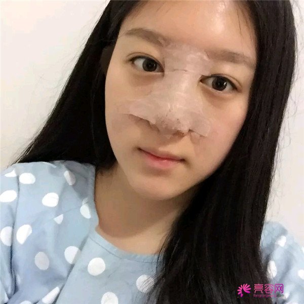 小仙女儿的鼻部手术案例分享连载(一)
