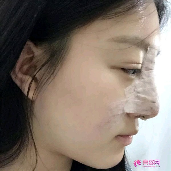 小仙女儿的鼻部手术案例分享连载(一)