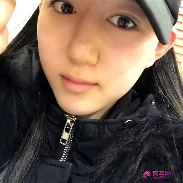 小仙女儿的鼻部手术案例分享连载(一)