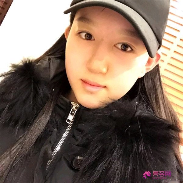 小仙女儿的鼻部手术案例分享连载(一)