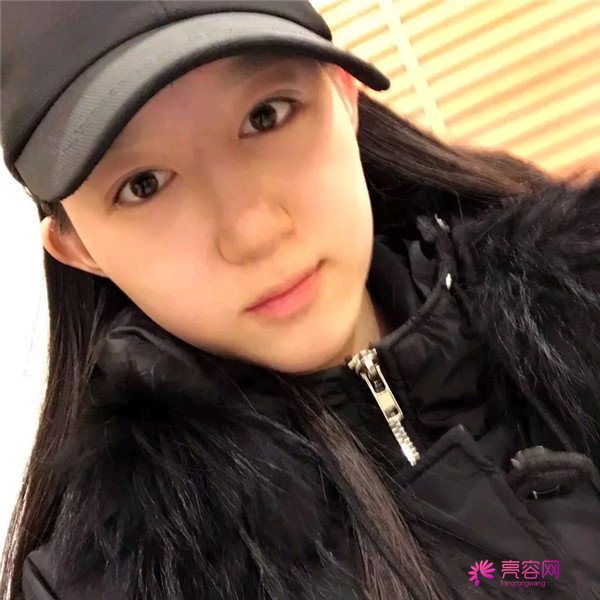 小仙女儿的鼻部手术案例分享连载(一)