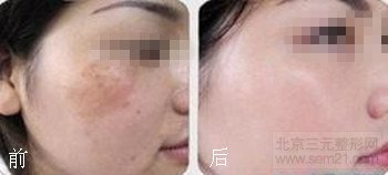 祛斑要多少钱?激光祛斑的价格是多少?