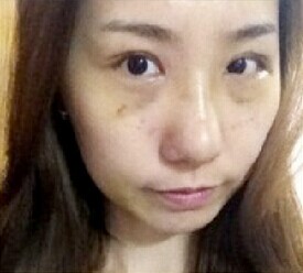 双眼皮隆鼻和脂肪填充,帮我找回了自信