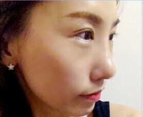 双眼皮隆鼻和脂肪填充,帮我找回了自信