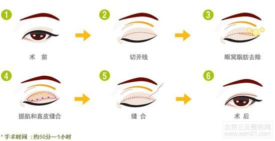 双眼皮切割 韩国全切双眼皮过程