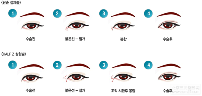 韩国开眼角 韩国开眼角做的好不好?