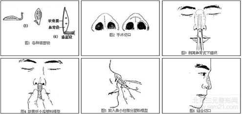 矮鼻矫正 韩国矮鼻矫正(假体)多少钱?怎么样?