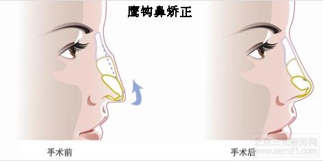 鹰钩鼻矫正 韩国鹰钩鼻矫正手术方法,矫正案例。