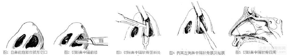 歪鼻矫正 韩国歪鼻矫正手术方法?价格多少钱?