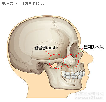 韩国颧骨缩小手术做得怎么样?
