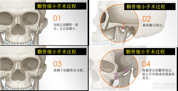 韩国颧骨缩小手术做得怎么样?