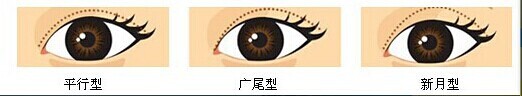 双眼皮有哪几种类型?