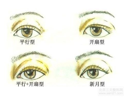 割双眼皮的类型有些什么?