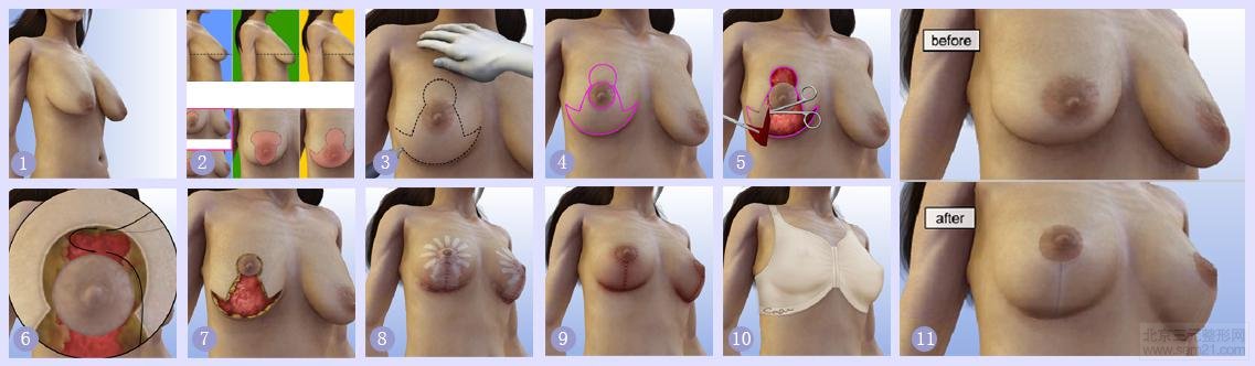 乳房下垂提升示意图 韩国乳房下垂提升手术【过程、案例图、副作用
