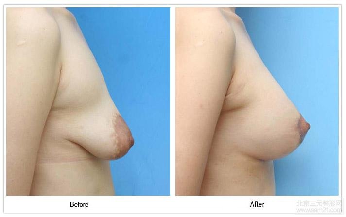 韩国乳房下垂提升案例图 韩国乳房下垂提升手术【过程、案例图、副作用