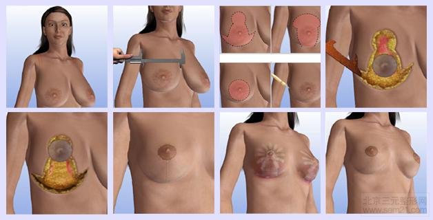 巨乳缩小手术过程图 韩国巨乳缩小手术方法,案例图和后遗症