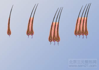 毛发移植示意图2 韩国毛发移植优势和术后注意事项