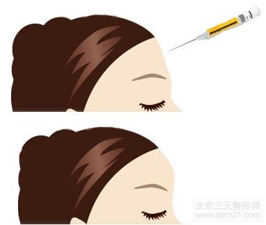 额头填充案例图 面部填充【案例|方法|介绍】
