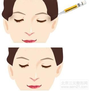 太阳穴填充案例图 面部填充【案例|方法|介绍】