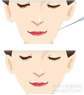 面颊填充案例图 面部填充【案例|方法|介绍】