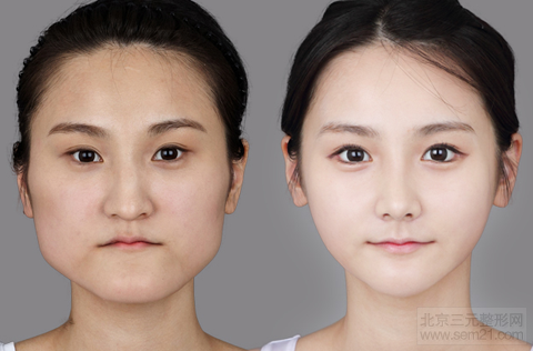 磨骨案例图 磨骨会下垂吗?有什么风险?副作用?