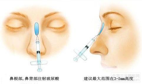 脂肪隆鼻案例图 脂肪隆鼻、玻尿酸隆鼻介绍