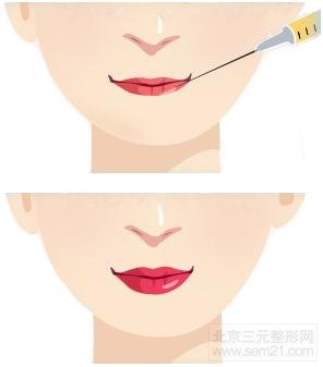 丰唇示意图 脂肪丰唇、玻尿酸丰唇介绍
