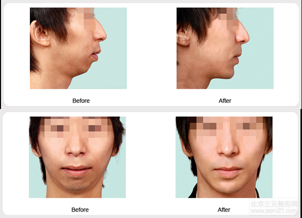 <a class='title-prefix' href='https://www.jszxmr1.com/dianxiaba/' target='_blank'>垫下巴</a>案例图 玻尿酸注射、脂肪隆下巴怎么样?