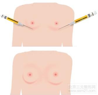 隆胸示意图 脂肪丰胸怎么样?好不好?