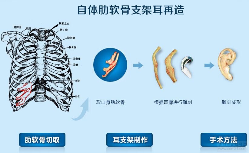 上海东方丽人吴建明耳朵再造怎么样?果好吗