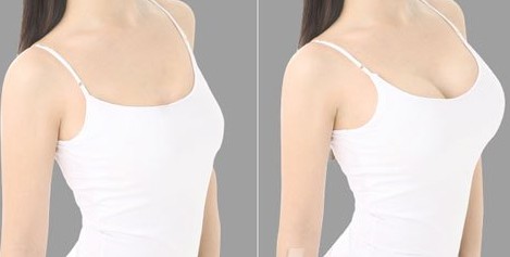 乳房下垂有那些危害?矫正有那些方法?