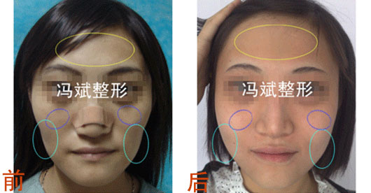 北京东方和谐冯斌<a class='title-prefix' href='https://www.beibei1.com/zhishi/' target='_blank'>整形案例</a> 北京冯斌自体脂肪丰苹果肌案例图