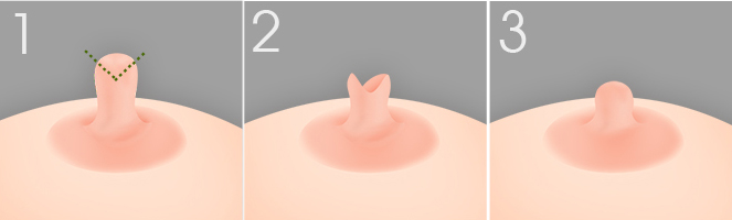 那些人适合乳晕缩小术,其中有你吗?