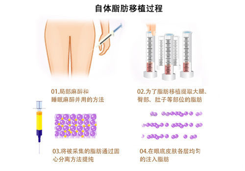 自体脂肪移植脂肪的成活率是多少?